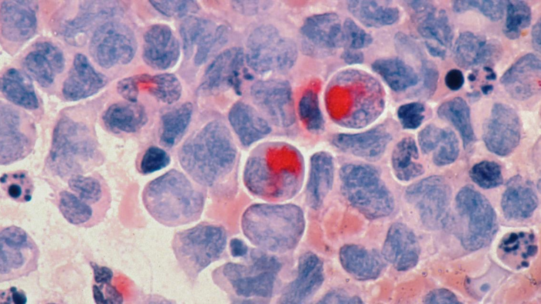 Acute myelocytic leukaemia (AML) cells under the microscope